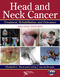 Head and Neck Cancer